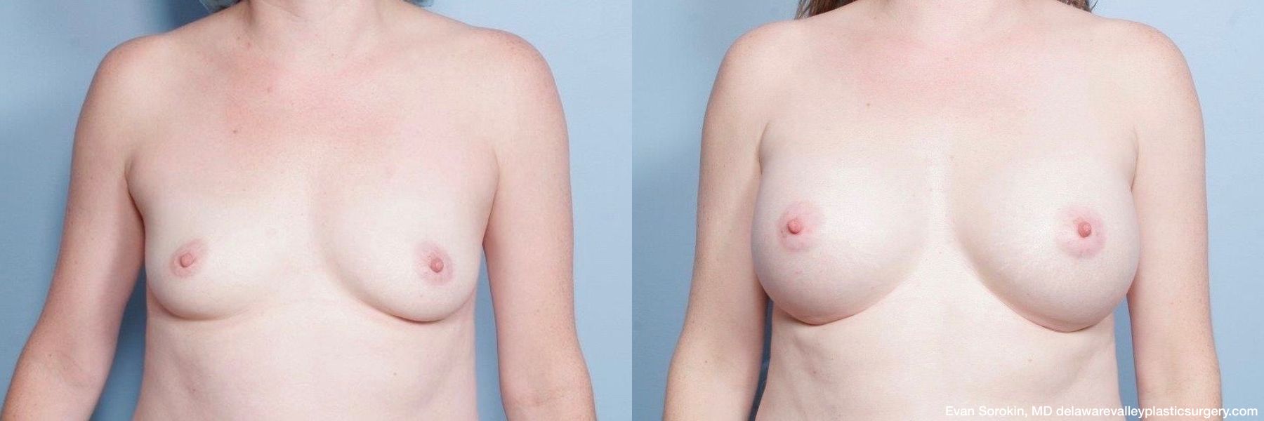 Breast Augmentation - Case 1489183