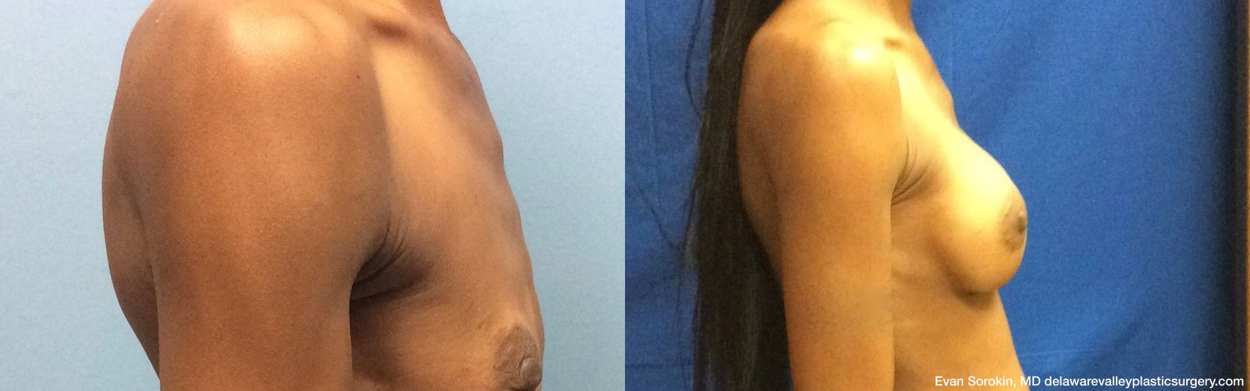 Breast Augmentation - Thumbnail 3