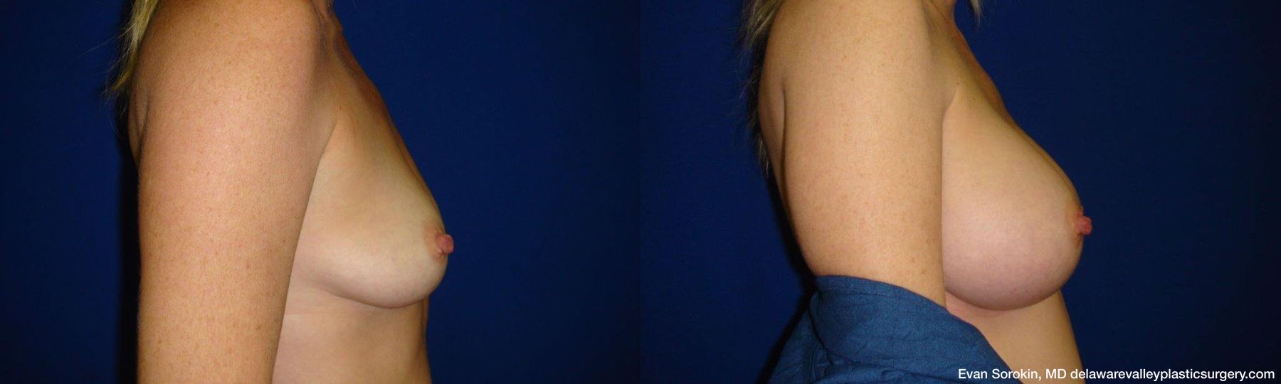 Breast Augmentation - Thumbnail 3