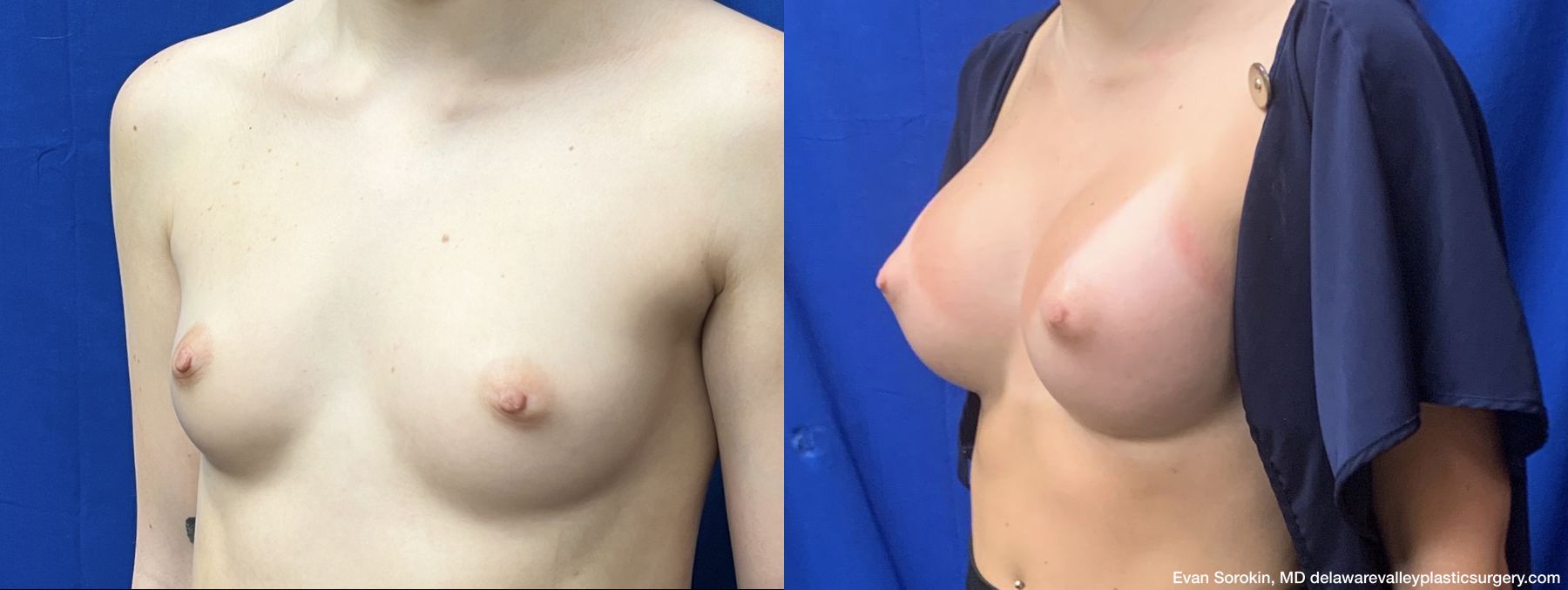 Breast Augmentation - Thumbnail 4