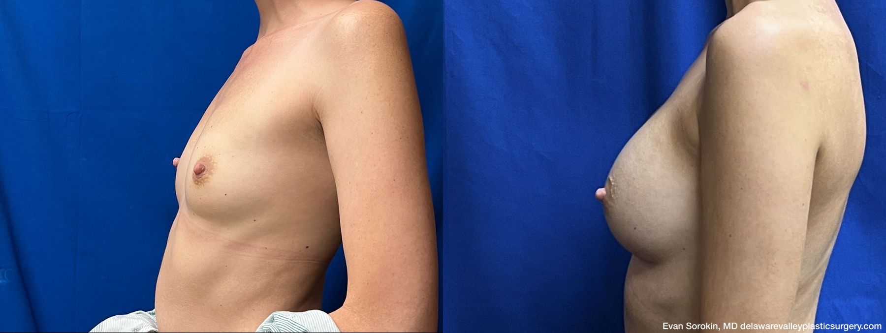 Breast Augmentation - Thumbnail 5