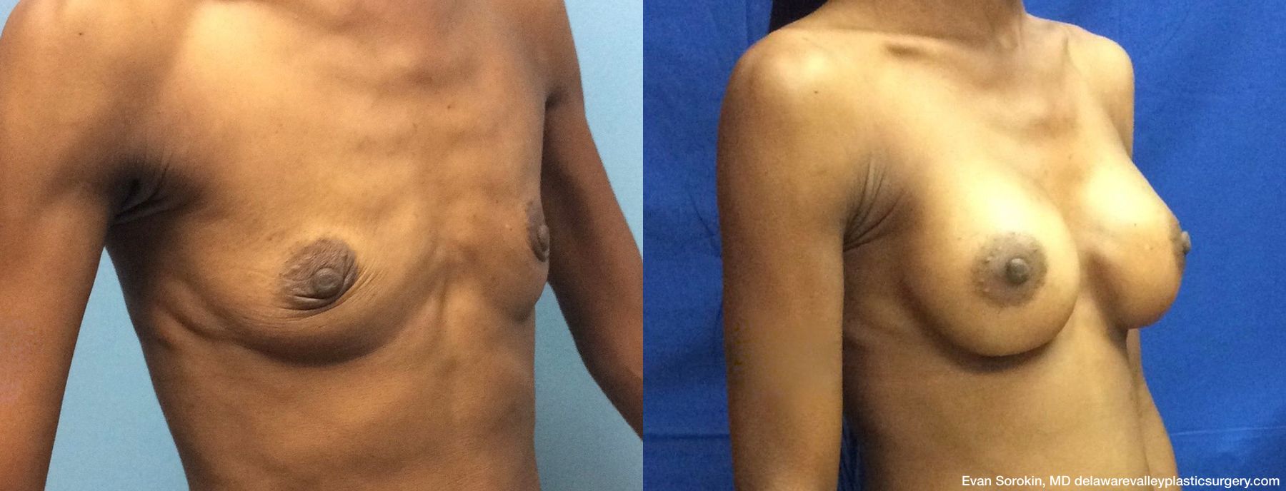 Breast Augmentation - Thumbnail 2