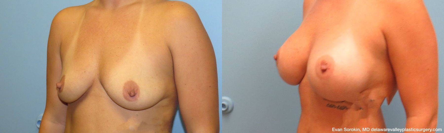 Breast Augmentation - Thumbnail 4