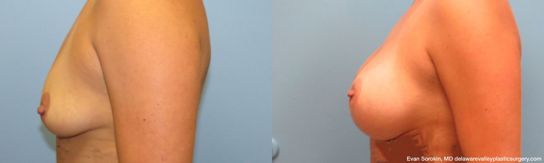 Breast Augmentation - Thumbnail 5