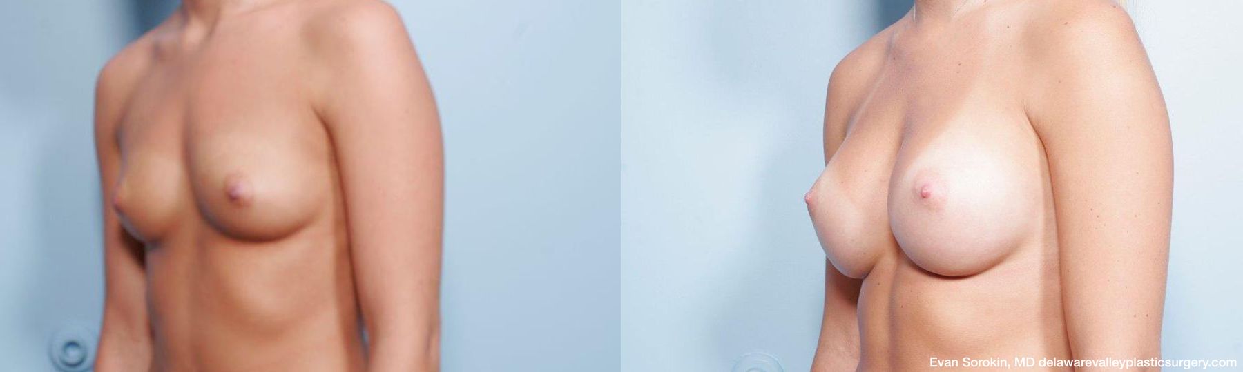 Breast Augmentation - Thumbnail 4