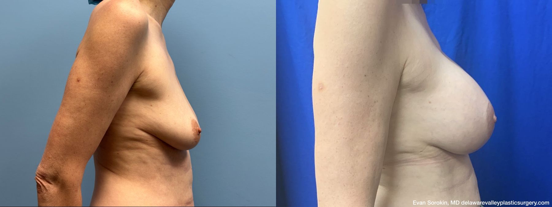 Breast Augmentation - Thumbnail 3