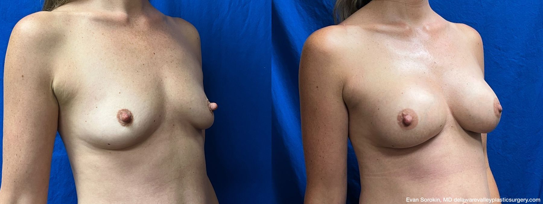 Breast Augmentation - Thumbnail 2