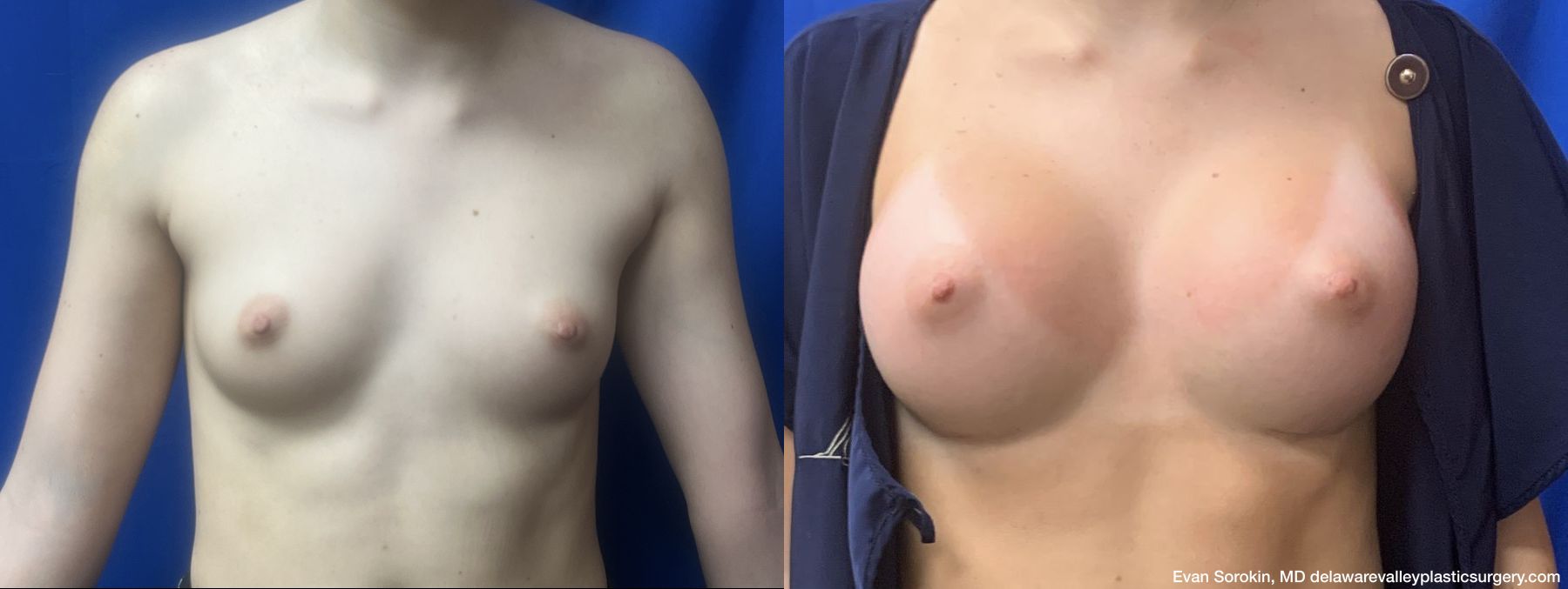 Breast Augmentation - Case 1488978