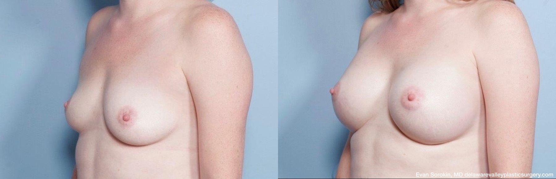 Breast Augmentation - Thumbnail 3