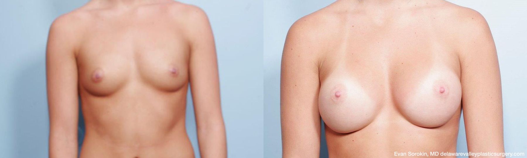 Breast Augmentation - Case 1489143