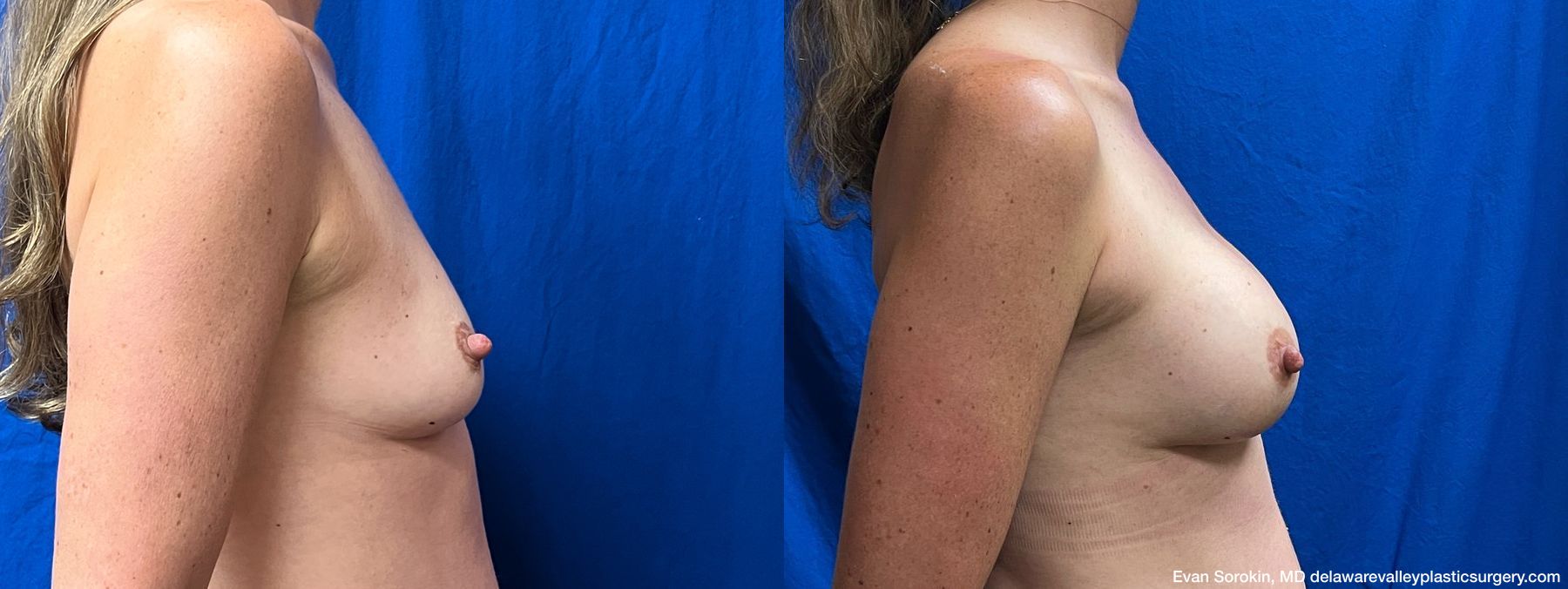 Breast Augmentation - Thumbnail 3