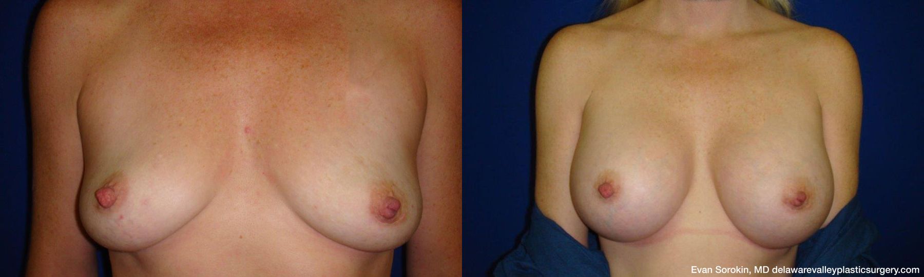 Breast Augmentation - Case 1489152