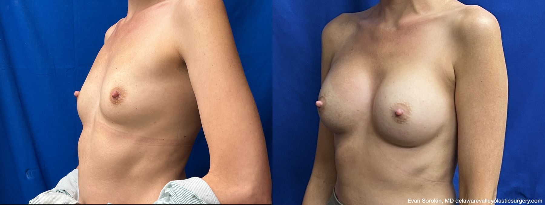 Breast Augmentation - Thumbnail 4