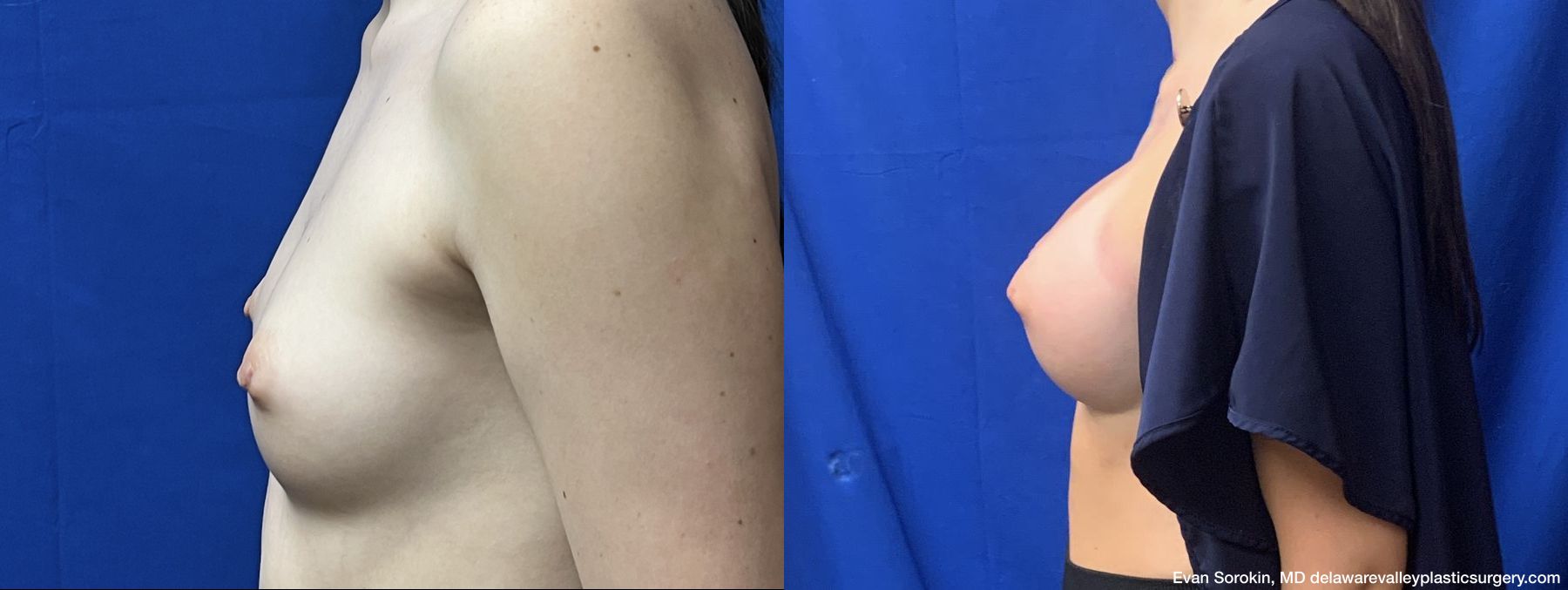 Breast Augmentation - Thumbnail 5