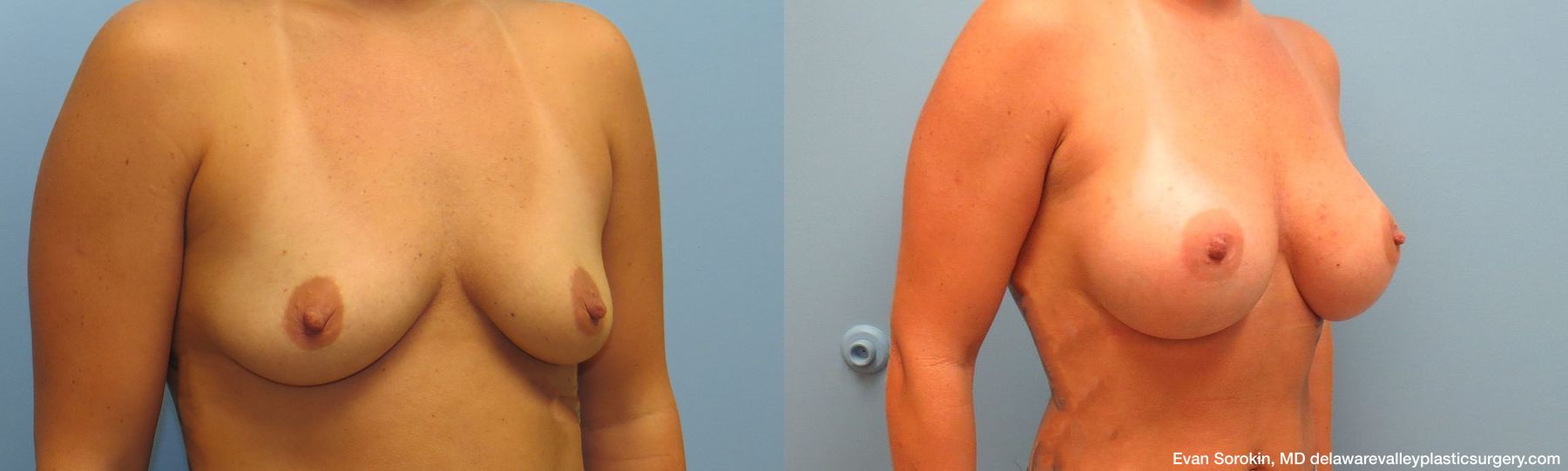 Breast Augmentation - Thumbnail 2