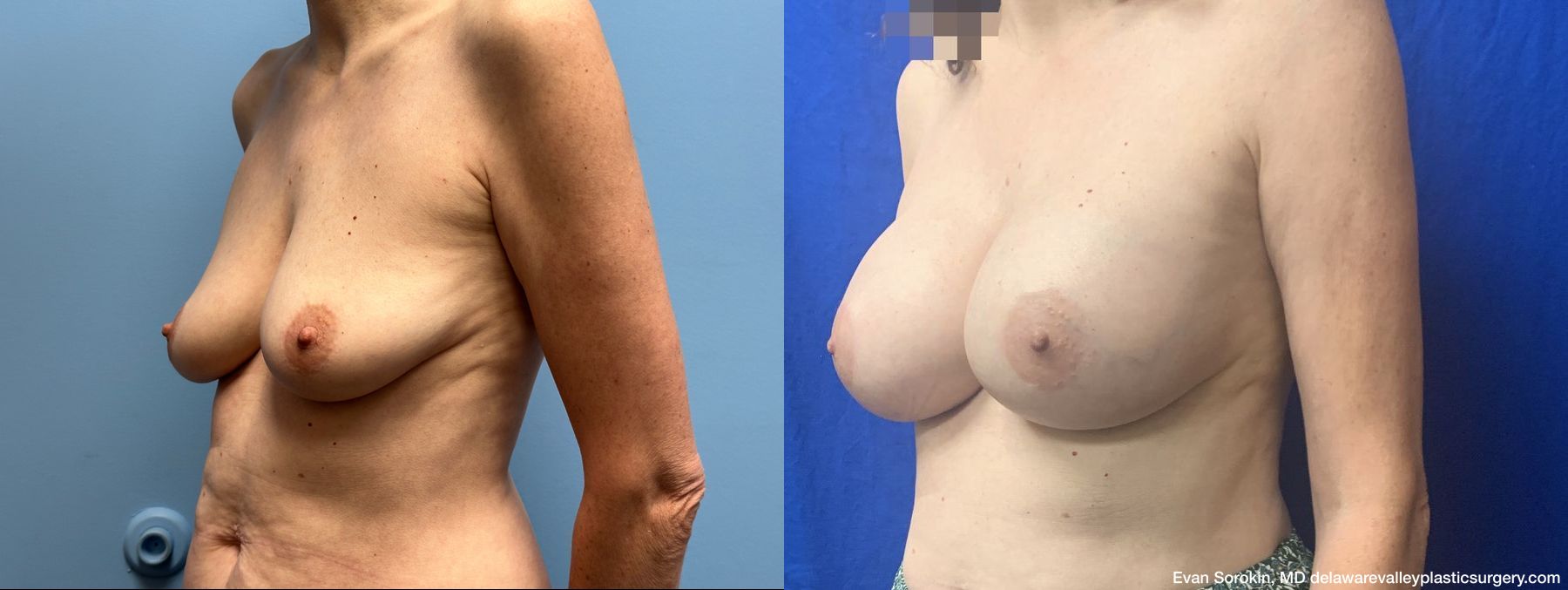 Breast Augmentation - Thumbnail 4