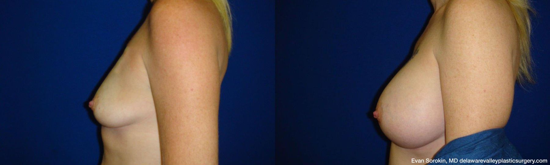 Breast Augmentation - Thumbnail 5