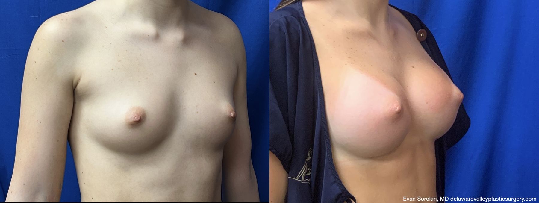 Breast Augmentation - Thumbnail 2