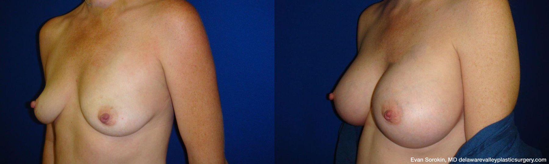 Breast Augmentation - Thumbnail 4