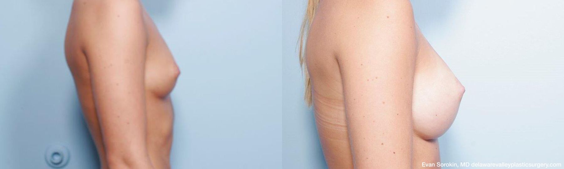 Breast Augmentation - Thumbnail 3