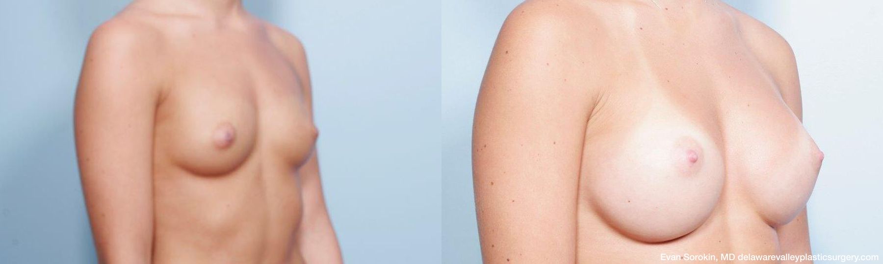 Breast Augmentation - Thumbnail 2