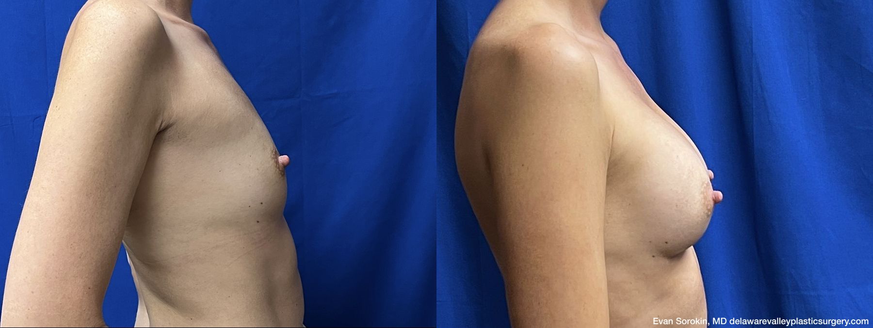 Breast Augmentation - Thumbnail 3