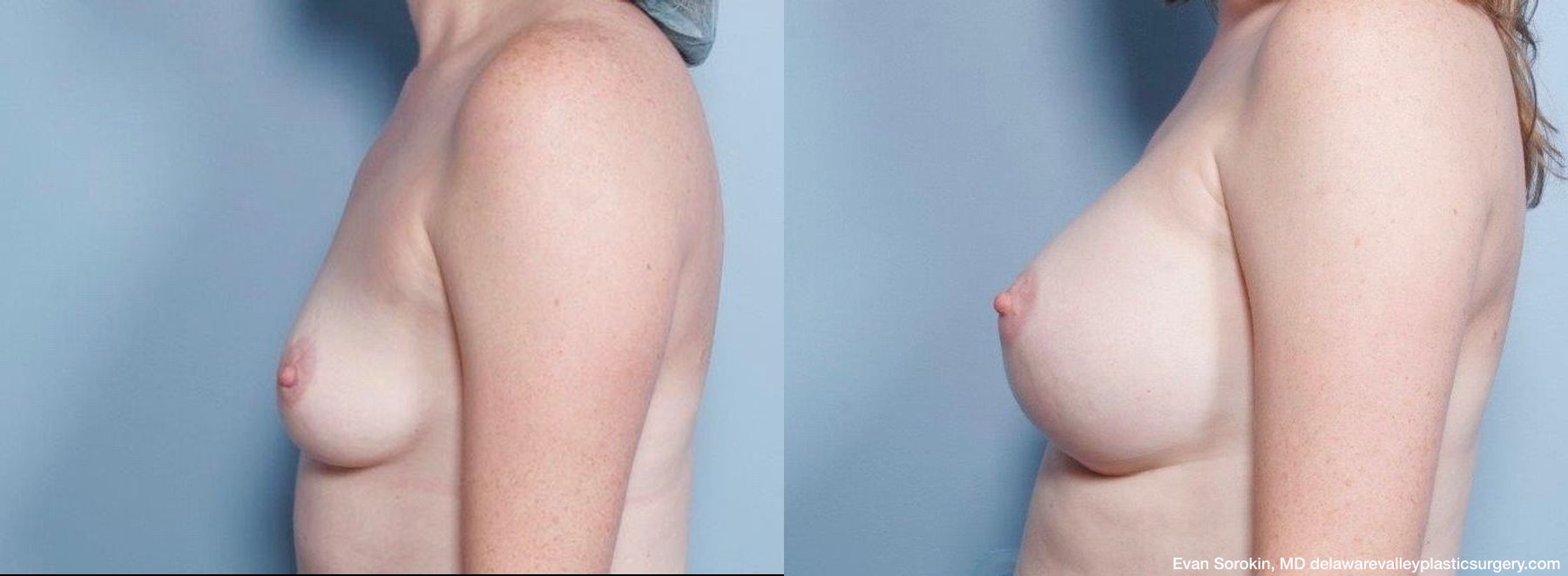 Breast Augmentation - Thumbnail 5