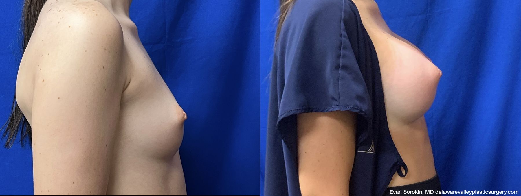 Breast Augmentation - Thumbnail 3