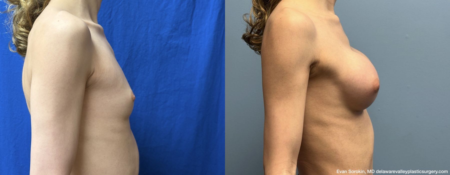 Top Surgery - Thumbnail 3