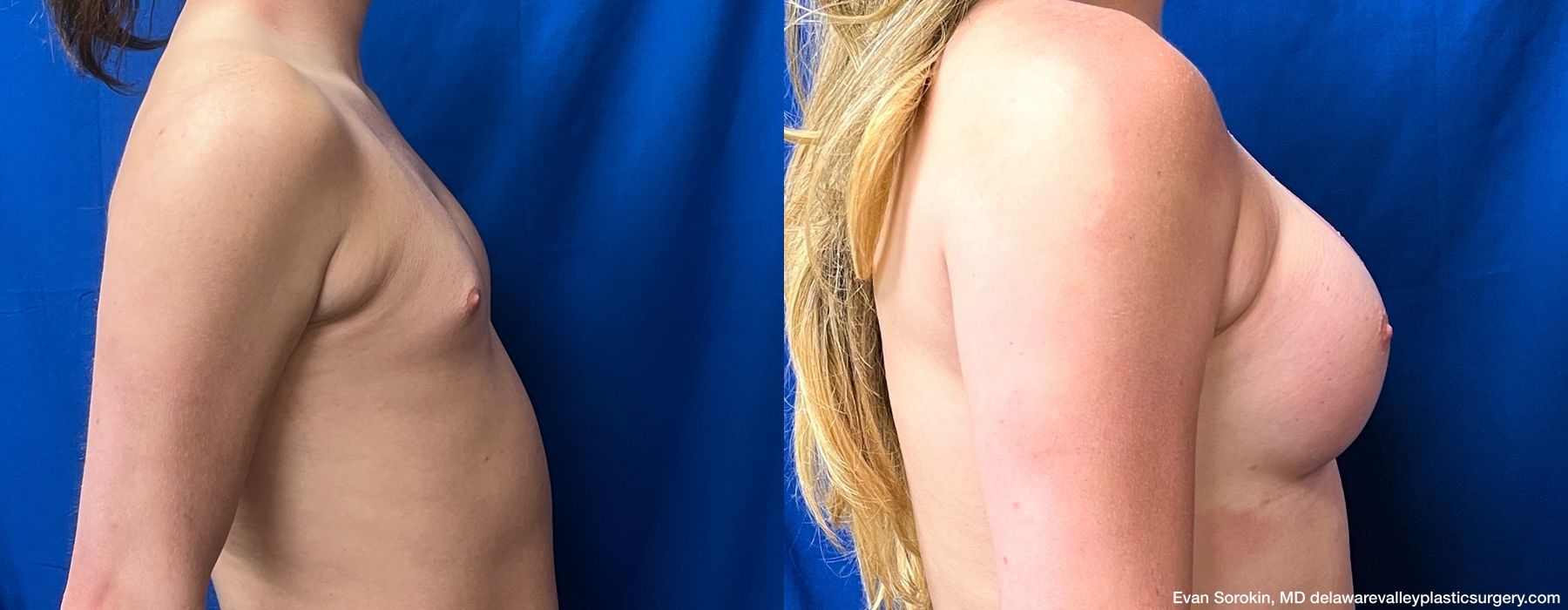 Top Surgery - Thumbnail 3