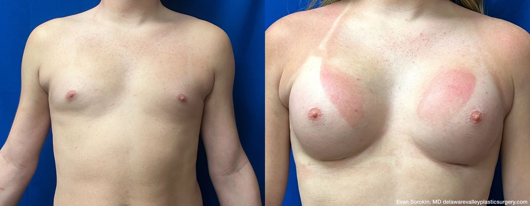 Top Surgery - Case 1489327