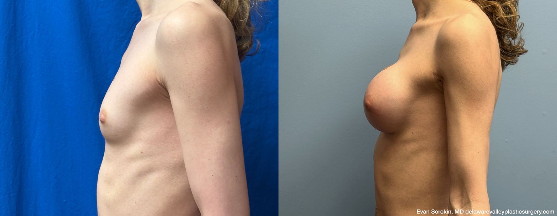 Top Surgery - Thumbnail 5