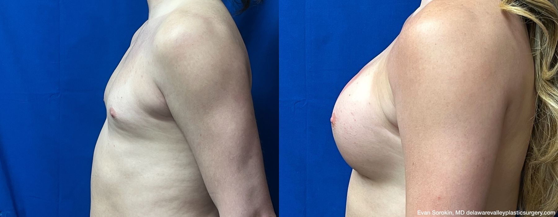 Top Surgery - Thumbnail 5