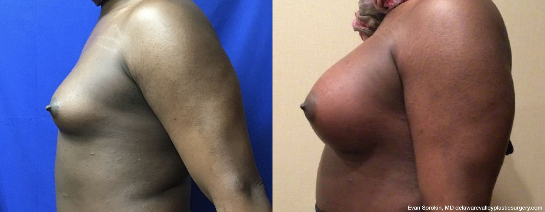 Top Surgery - Thumbnail 3