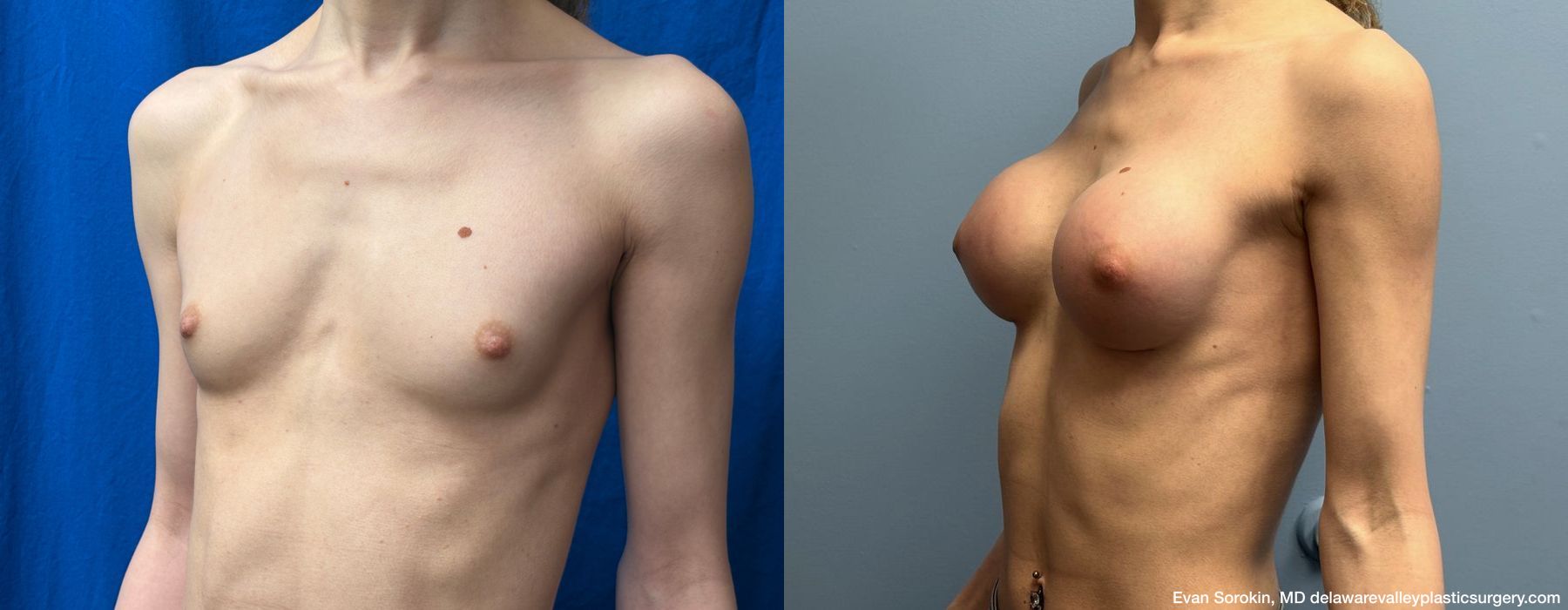 Top Surgery - Thumbnail 4