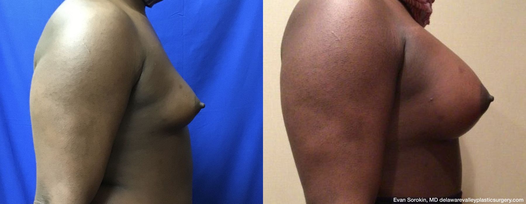 Top Surgery - Thumbnail 2