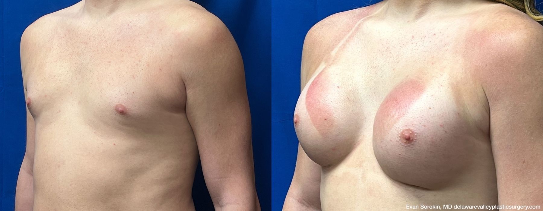 Top Surgery - Thumbnail 4