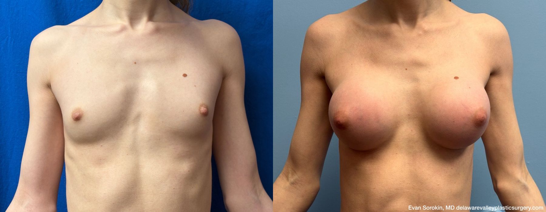 Top Surgery - Case 1489322