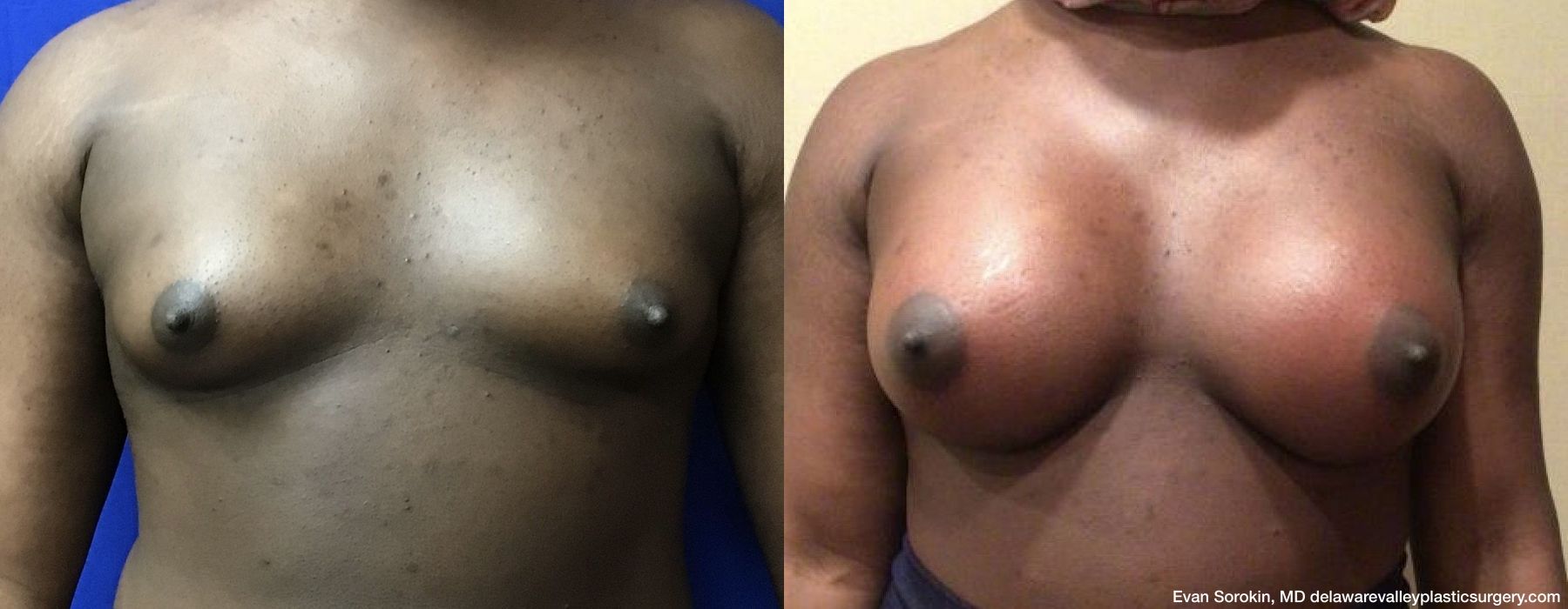 Top Surgery - Case 1489328