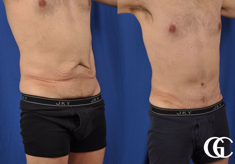 Abdominoplasty - Case 6911