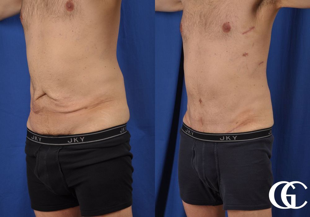 Abdominoplasty - Thumbnail 4