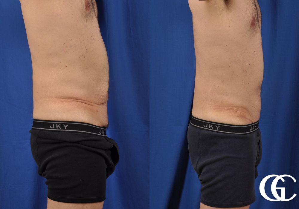 Abdominoplasty - Thumbnail 3