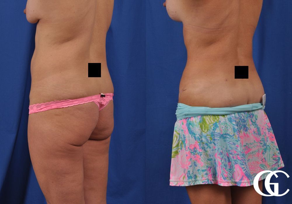 Abdominoplasty - Thumbnail 3