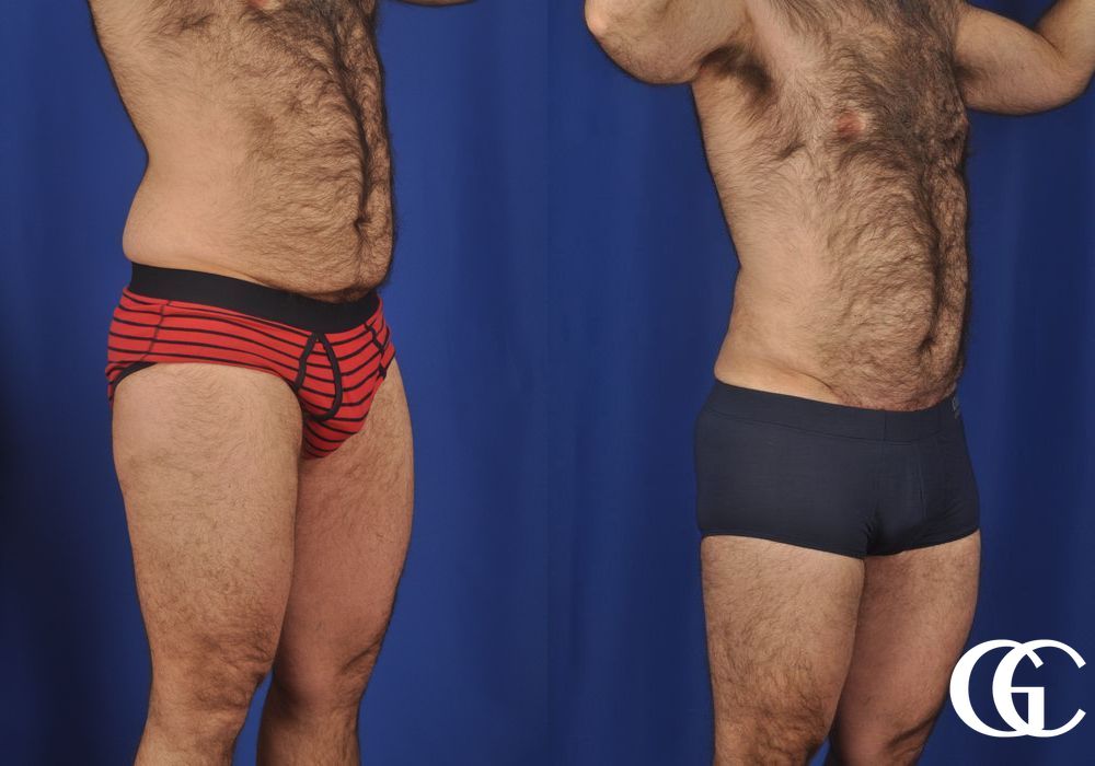 Abdominoplasty - Thumbnail 3