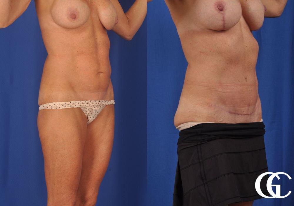 Abdominoplasty - Thumbnail 3