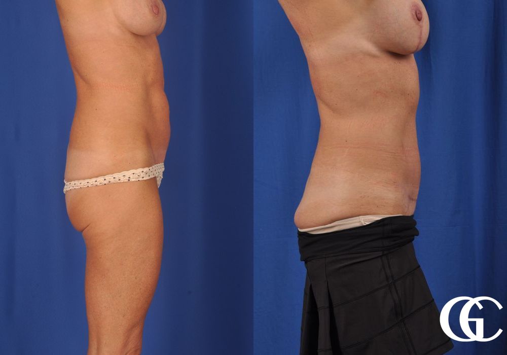 Abdominoplasty - Thumbnail 4