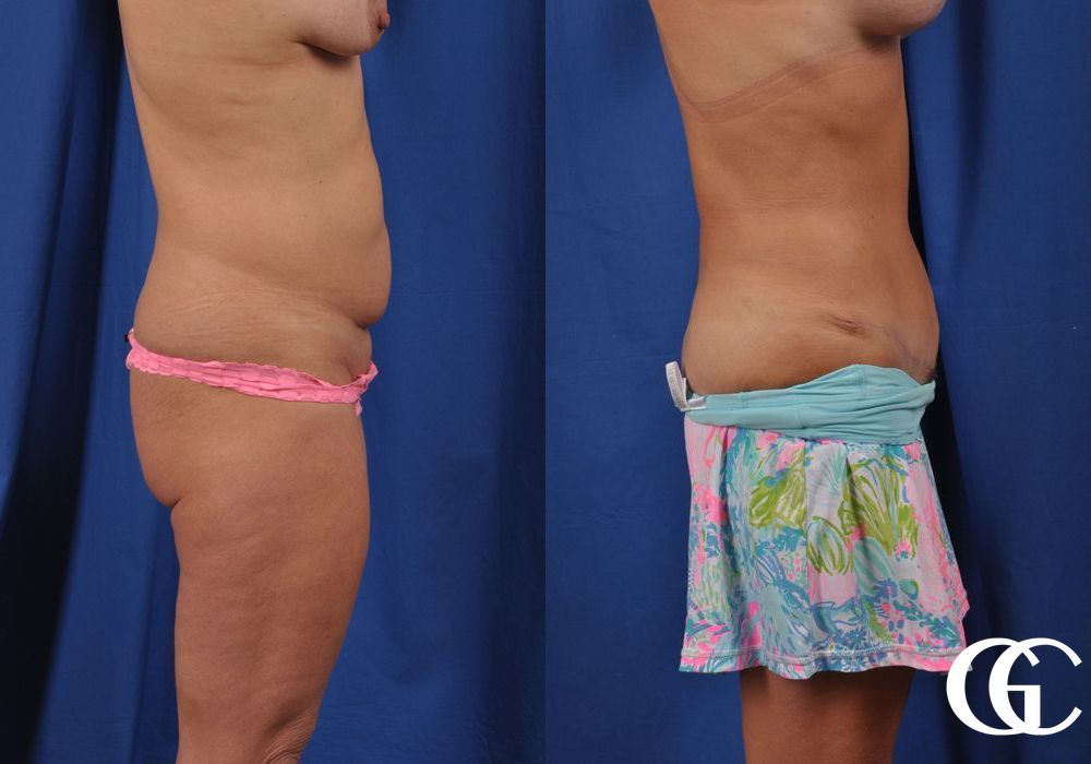 Abdominoplasty - Thumbnail 5