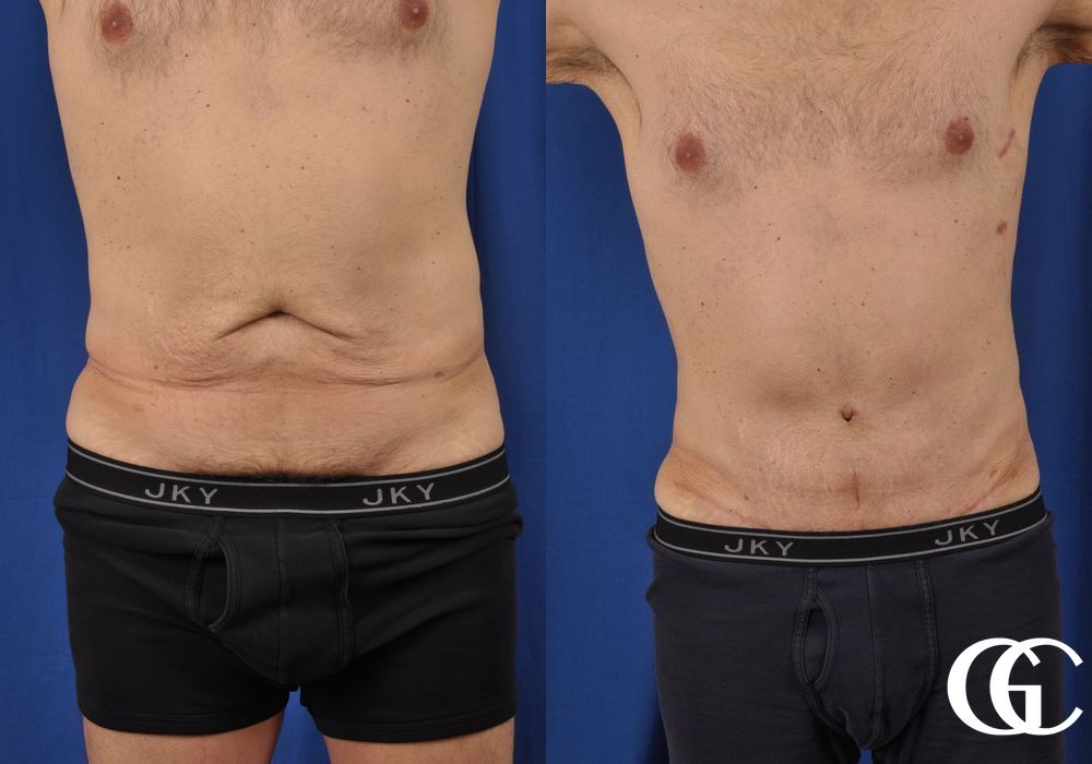 Abdominoplasty - Thumbnail 2