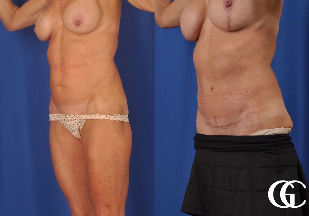 Abdominoplasty - Case 6909