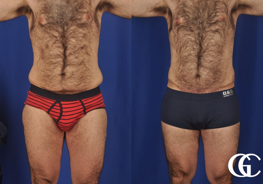 Abdominoplasty - Thumbnail 2